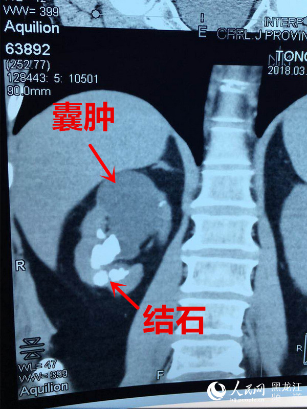 肾结石伴有肾囊肿 黑龙江省医院一次手术解除患者俩困扰