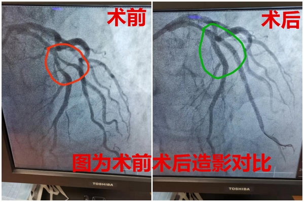 冠脉ct低估病变 黑龙江省医院专家"冠脉造影"找出"元凶"
